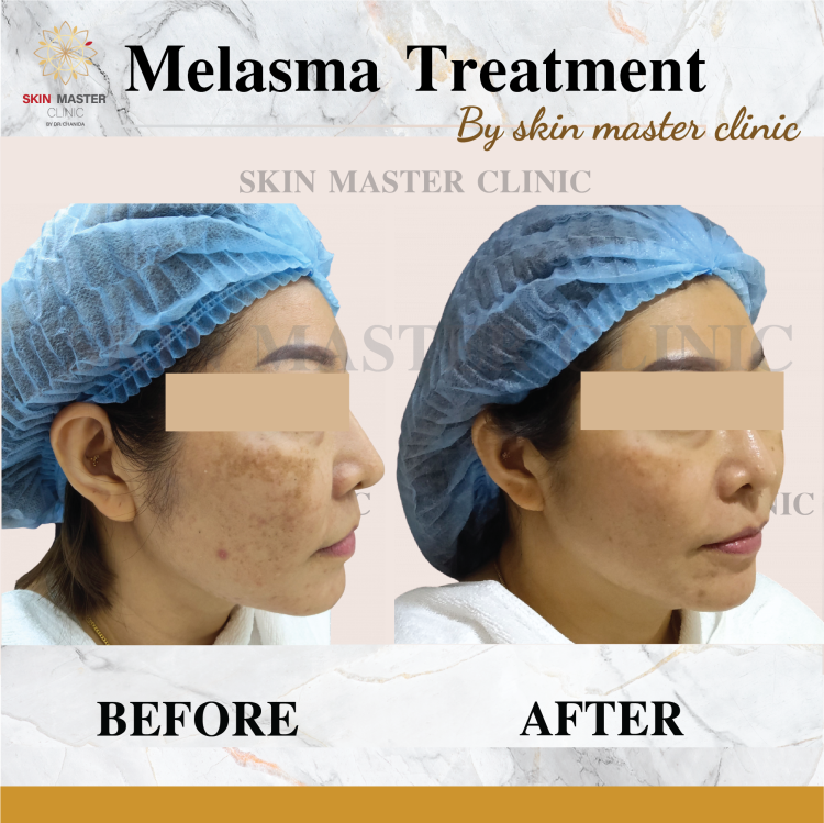 Review Picosecond laser skinmasterclinic