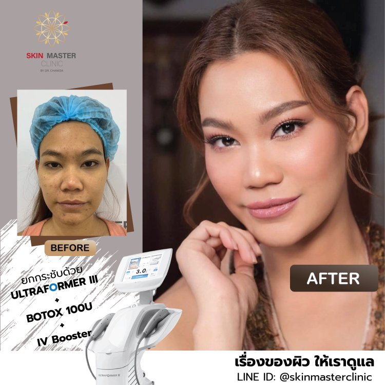 Review BOTOX - skinmaster-clinic