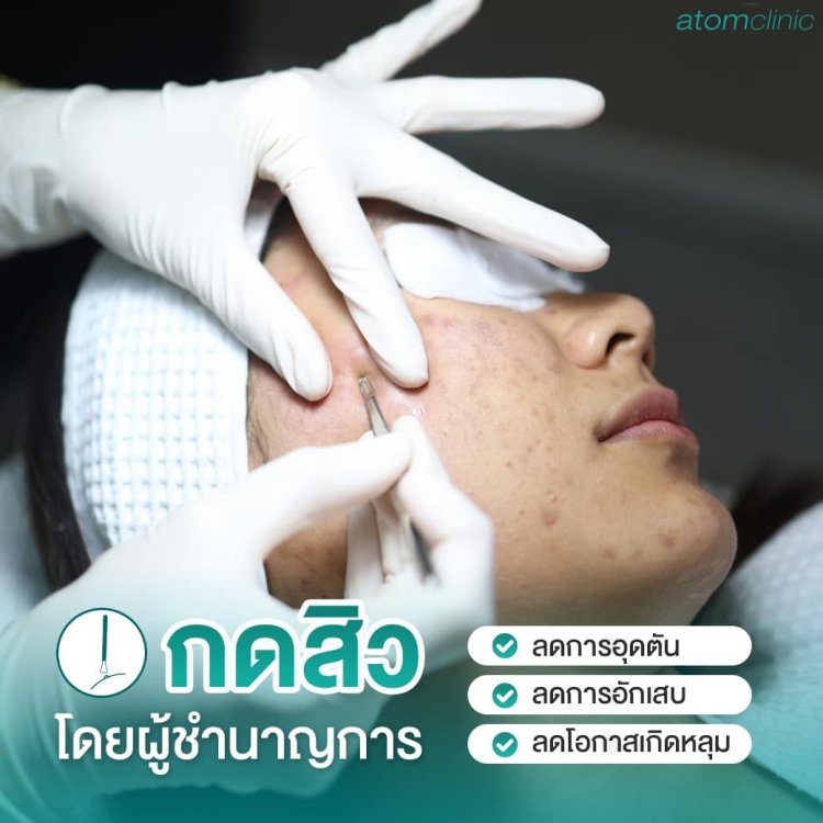 รักษาสิว สิวอักเสบ สิวอุดตัน อะตอมคลินิก