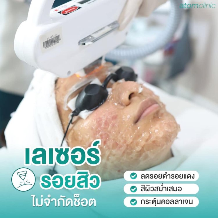 รักษาสิว สิวอักเสบ สิวอุดตัน อะตอมคลินิก