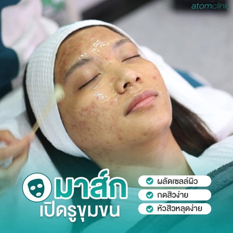 รักษาสิว สิวอักเสบ สิวอุดตัน อะตอมคลินิก