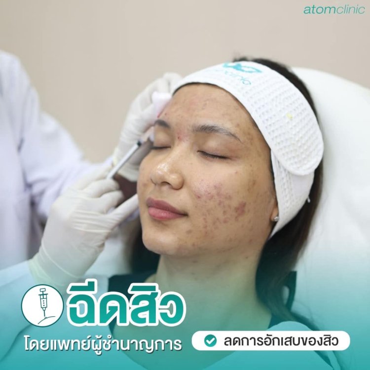 รักษาสิว สิวอักเสบ สิวอุดตัน อะตอมคลินิก