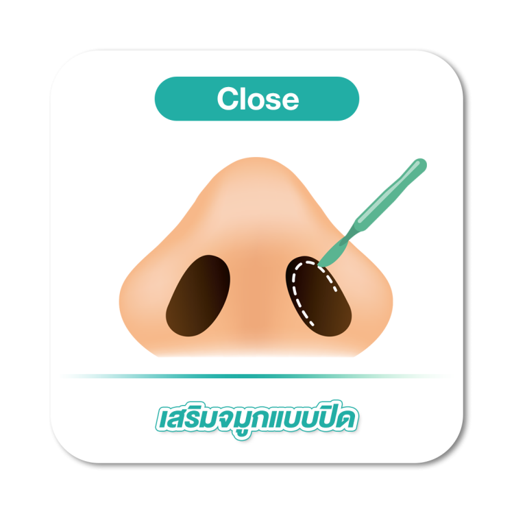 เสริมจมูก