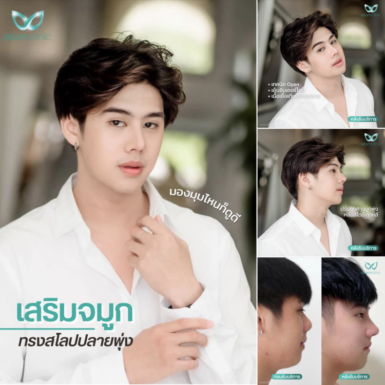 เสริมจมูก