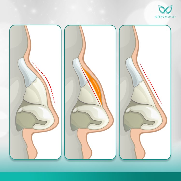 เสริมจมูก