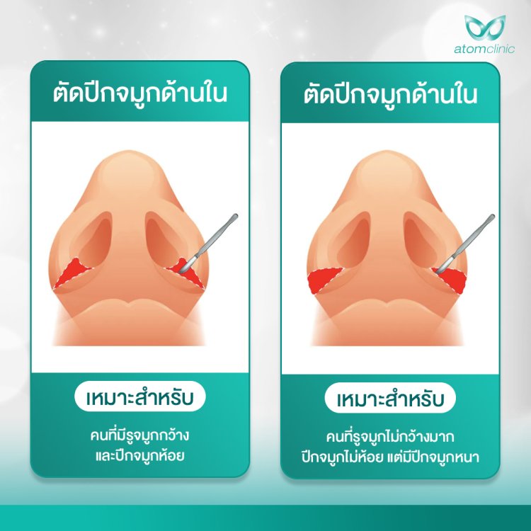 เสริมจมูก