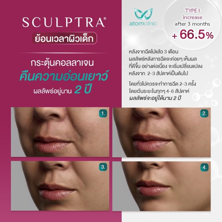 Sculptra Collagen Biostimulator