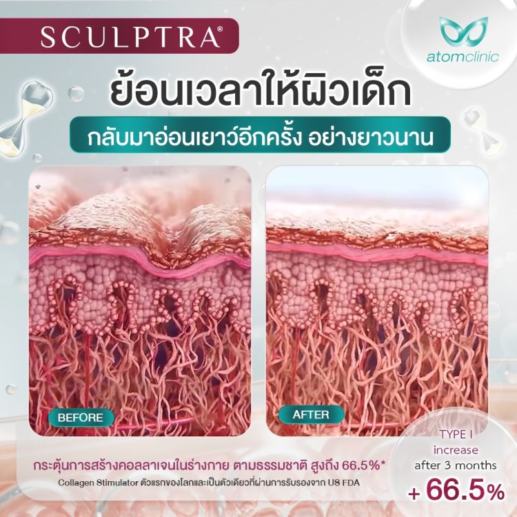 Sculptra Collagen Biostimulator