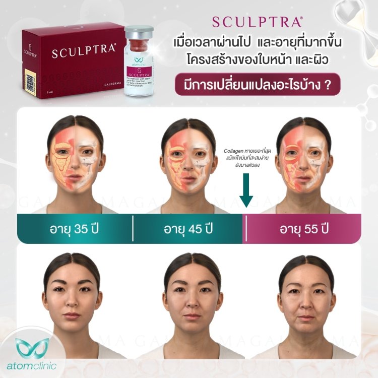 Sculptra Collagen Biostimulator
