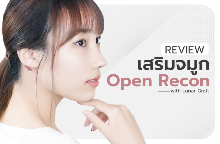 รีวิวเสริมจมูก open recon