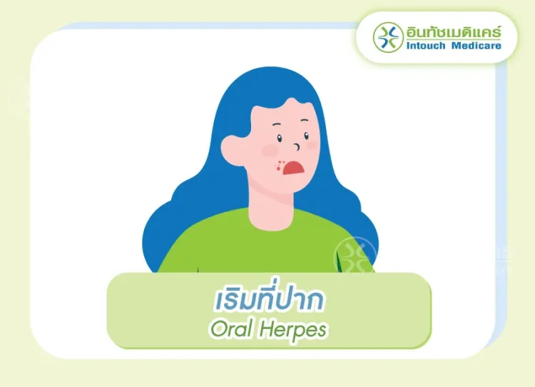 เริมที่ปาก เริมที่ริมฝีปาก เริมที่ปาก เริมที่ริมฝีปาก