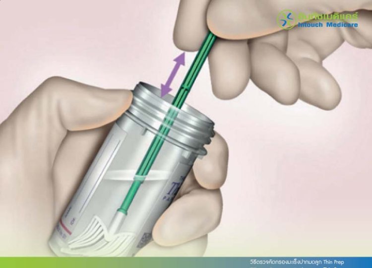 ตรวจคัดกรองมะเร็งปากมดลูกThin Prep ตรวจคัดกรองมะเร็งปากมดลูกThin Prep