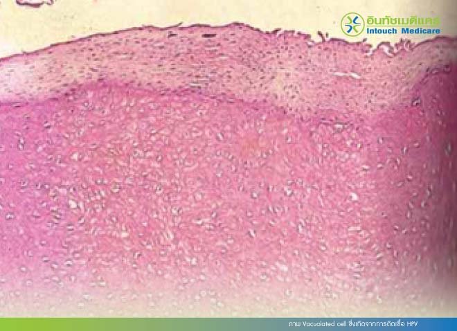 ภาพ Vacuolated cell ซึ่งเกิดจากการติดเชื้อ HPV ภาพ Vacuolated cell ซึ่งเกิดจากการติดเชื้อ HPV