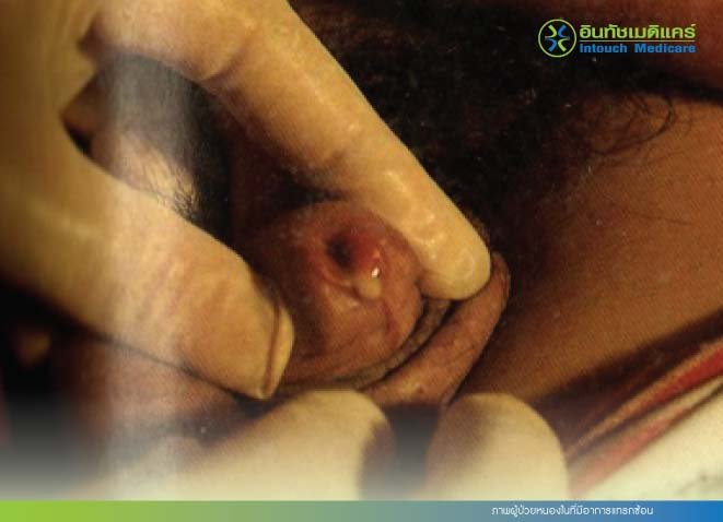 ภาพผู้ป่วยหนองในที่มีอาการแทรกซ้อน