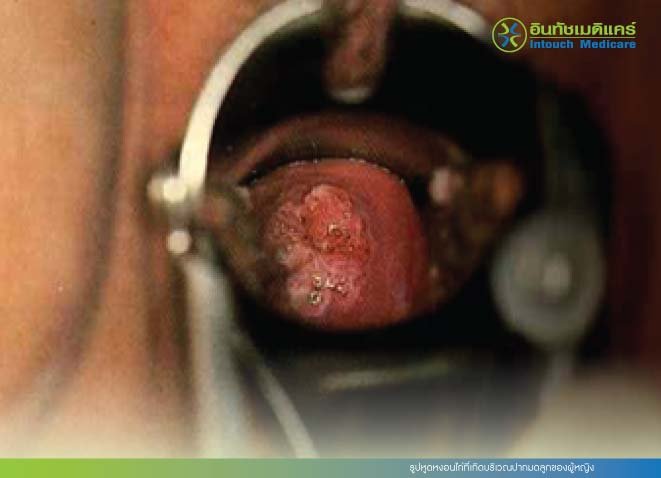 รูปหูดหงอนไก่ที่เกิดบริเวณปากมดลูกของผู้หญิง