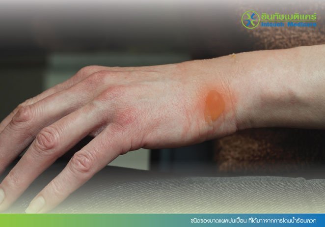 ชนิดของบาดแผลปนเปื้อน ที่ได้มาาจากการโดนน้ำร้อนลวก