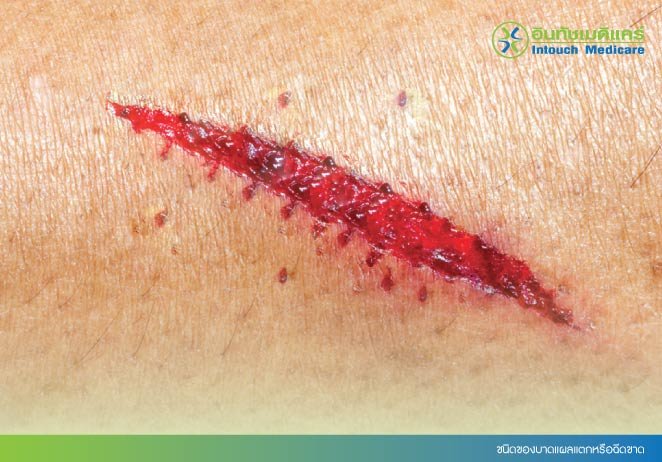 ชนิดของบาดแผลแตกหรือฉีดขาด