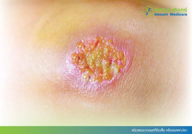 ชนิดของบาดแผลที่ติดเชื้อ หรือแผลสกปรก