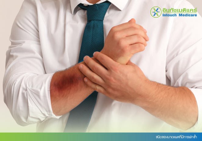 ชนิดของแผลที่มีการฟกช้ำ