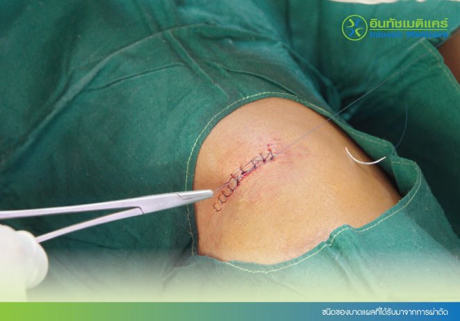 ชนิดของบาดแผลที่ได้รับมาจากการผ่าตัด
