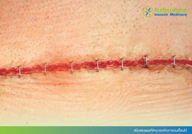 ชนิดของแผลที่สามารถเกิดการปนเปื้อนได้