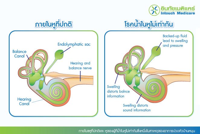 ภายในขหูที่ปกติและ หูของผู้ที่น้ำในหูไม่เท่ากันซึ่งหนึ่งในสาเหตุของอาการปวดหัวบ้านหมุน