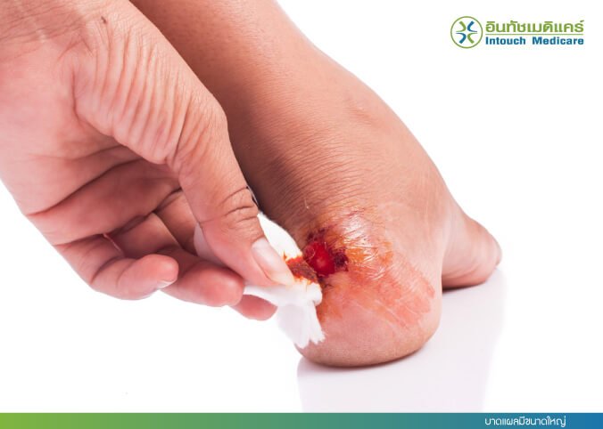 บาดแผลขนาดใหญ่