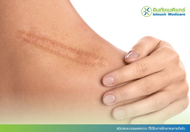 ชนิดของบาดแผลสะอาด ที่ได้รับการรักษาจนหายดีแล้ว