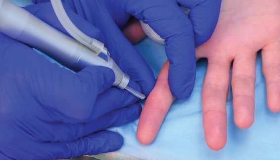 จี้หูด ฉีดคีลอยด์ ตัดติ่งเนื้อ