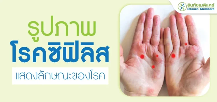 รูปภาพซิฟิลิส