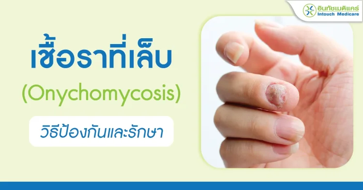 เชื้อราที่เล็บ วิธีป้องกันและรักษา