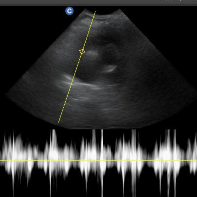 อัลตราซาวด์ อัลตราซาวด์
