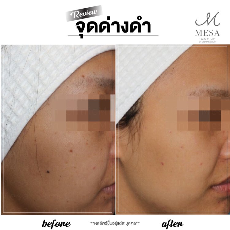 กระ จุดด่างดำ