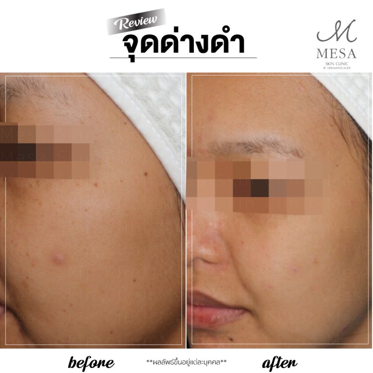 กระ จุดด่างดำ