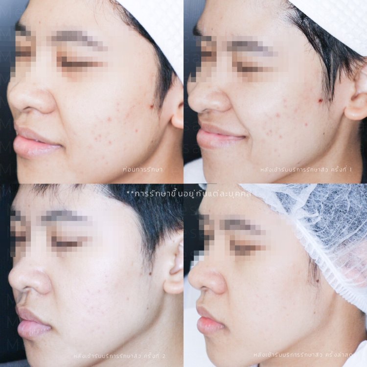 รักษาสิว