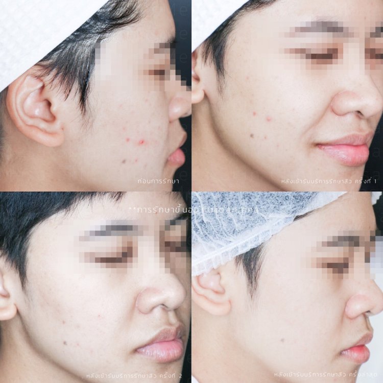 รักษาสิว