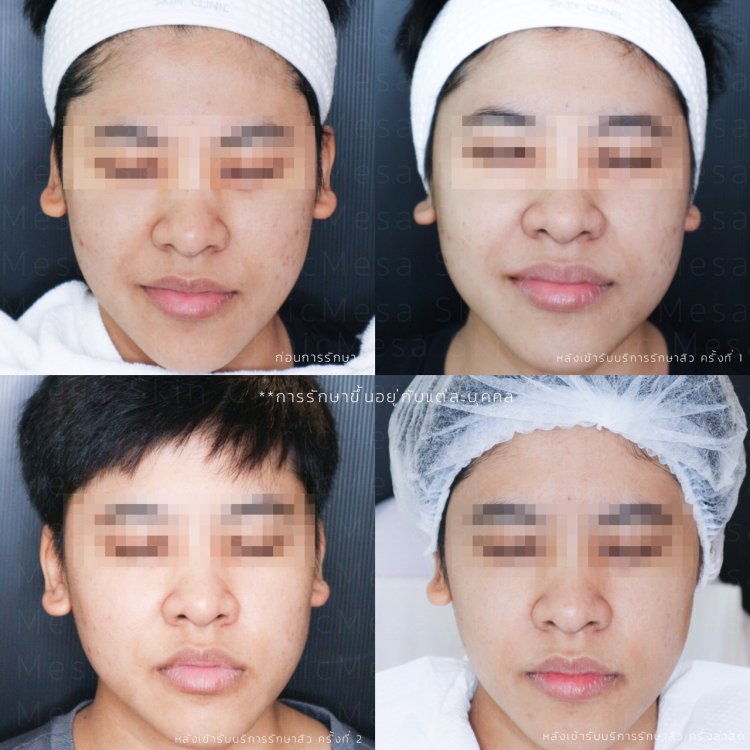 รักษาสิว