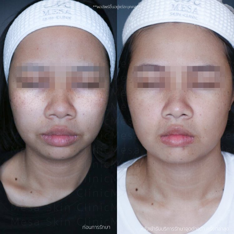 รักษากระ