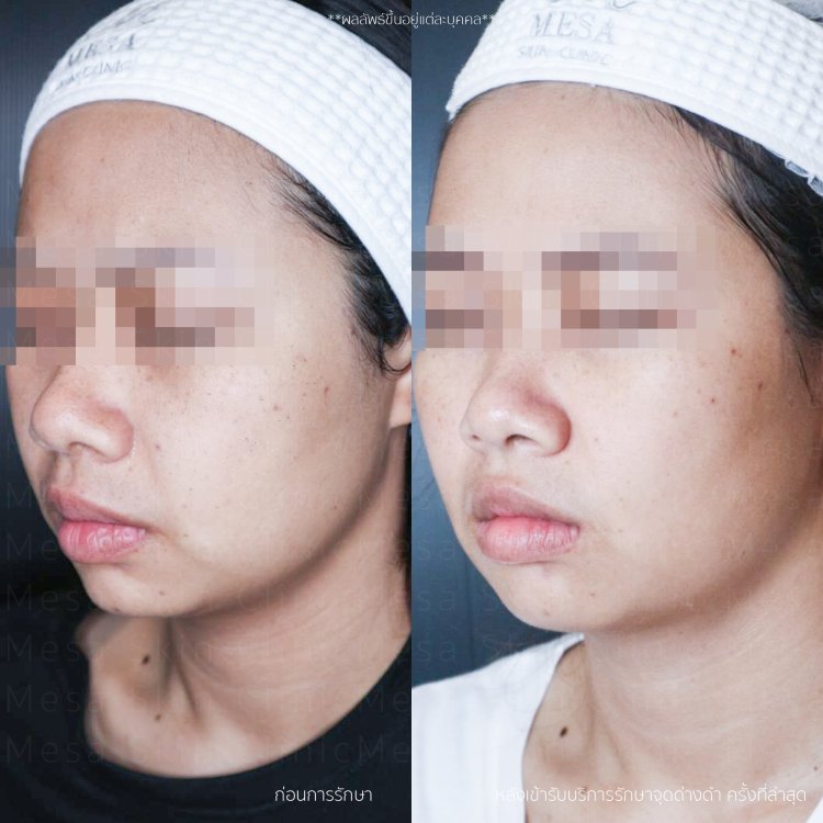 รักษากระ