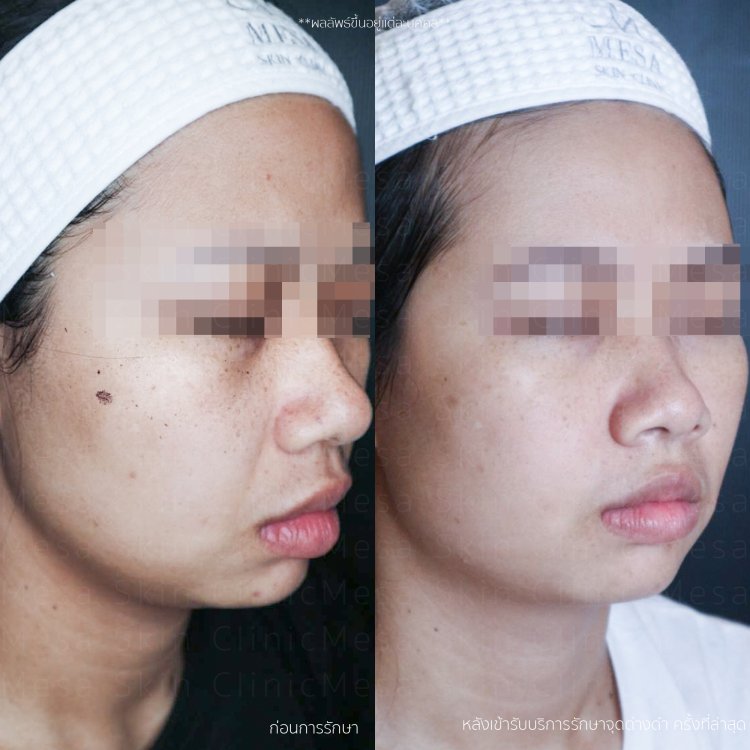 รักษากระ