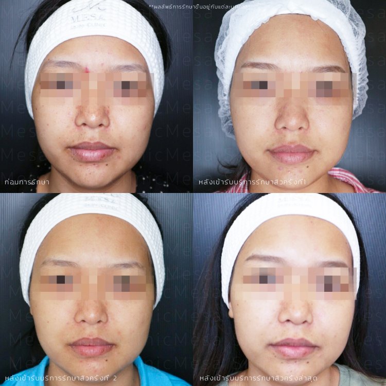 รักษาสิว 