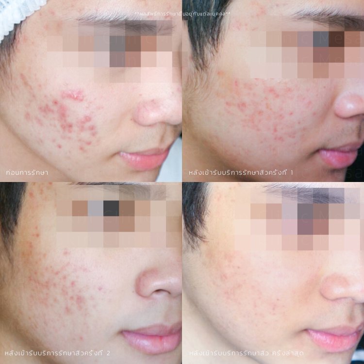 stop acne