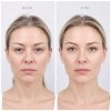 Endoscopic Browlift