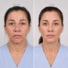 Endoscopic Browlift Endoscopic Browlift