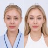 Endoscopic Browlift