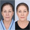 Endoscopic Browlift Endoscopic Browlift