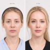Endoscopic Browlift Endoscopic Browlift