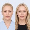 Endoscopic Browlift