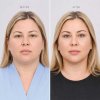 Endoscopic Browlift