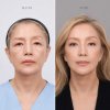 Endoscopic Browlift Endoscopic Browlift